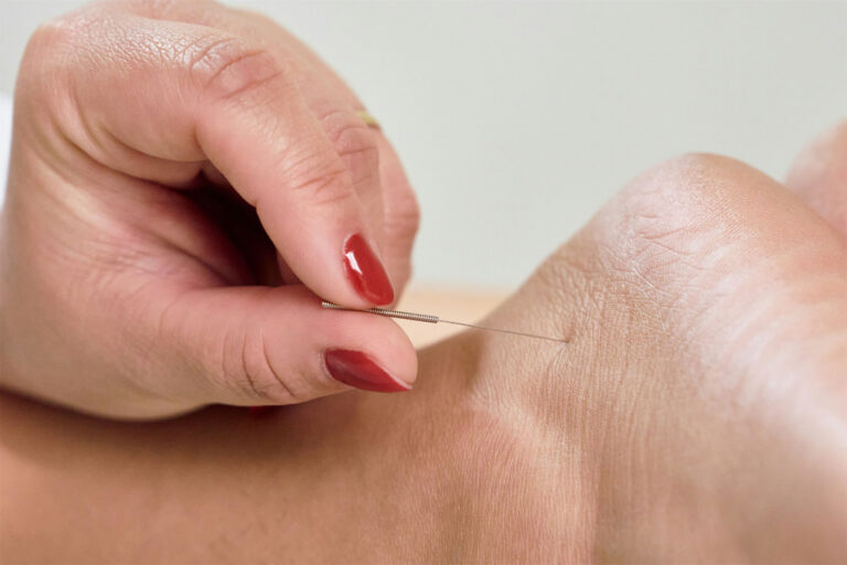 Acupuncture needles being placed along a forearm